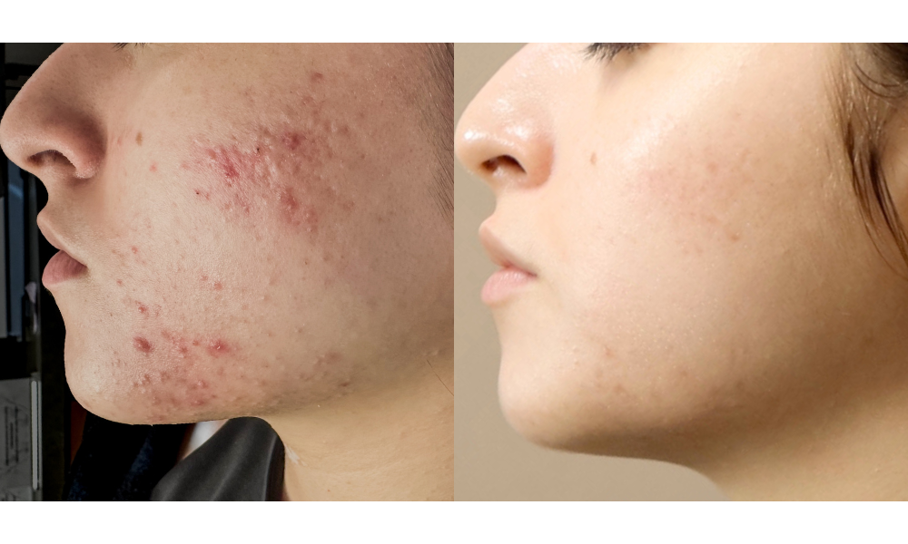 acne treatment and facial