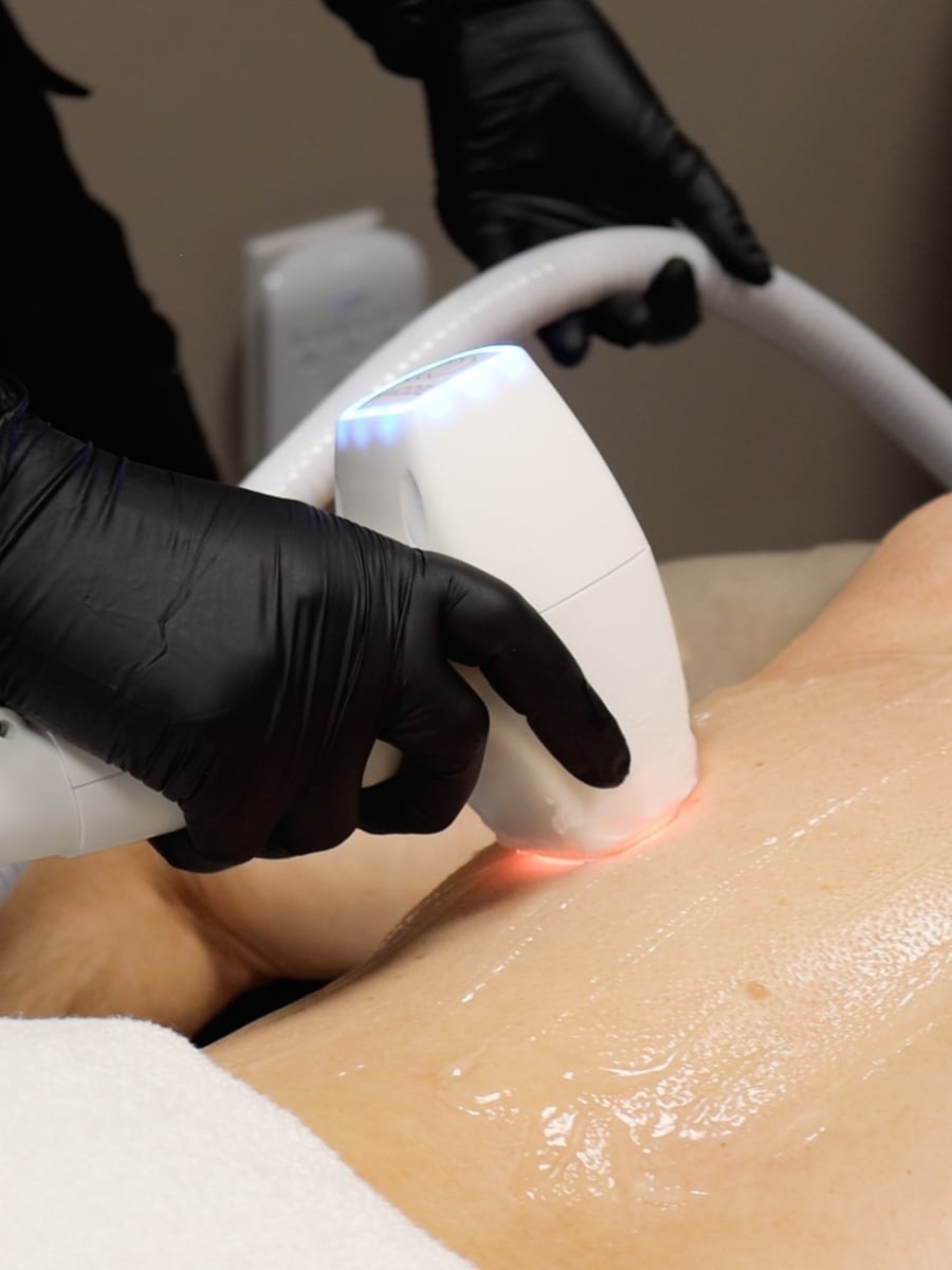 laser hair removal