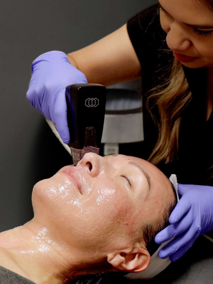 Morpheus8 RF Microneedling