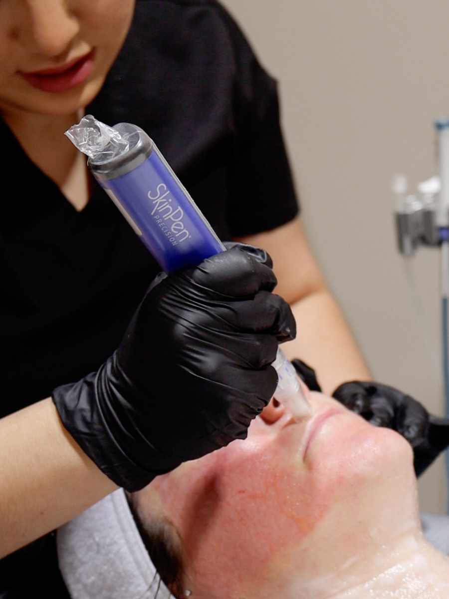skinpen microneedling