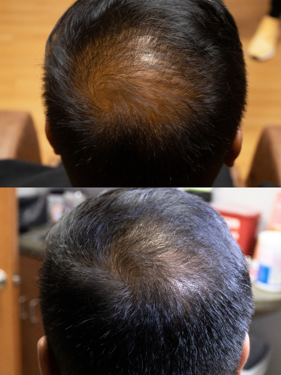 PRF hair thinning treatment