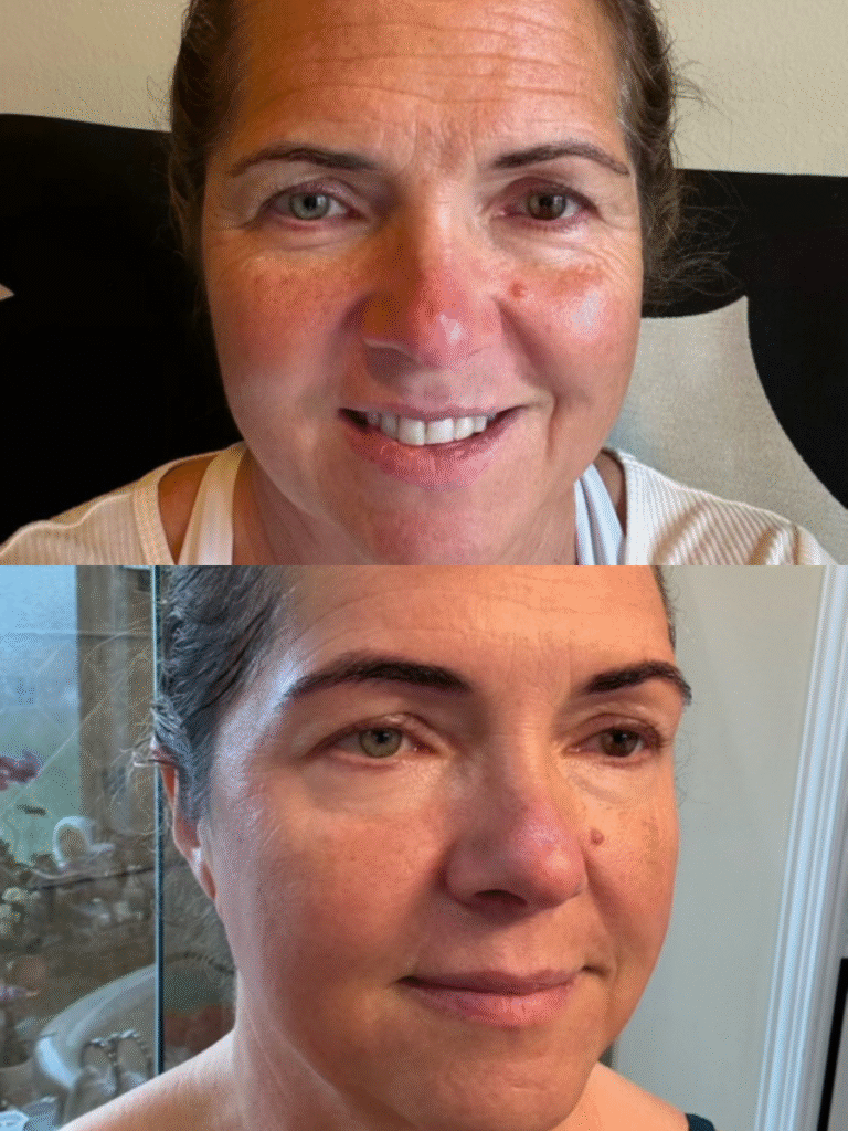 PRP and PRF microneedling treatment 2
