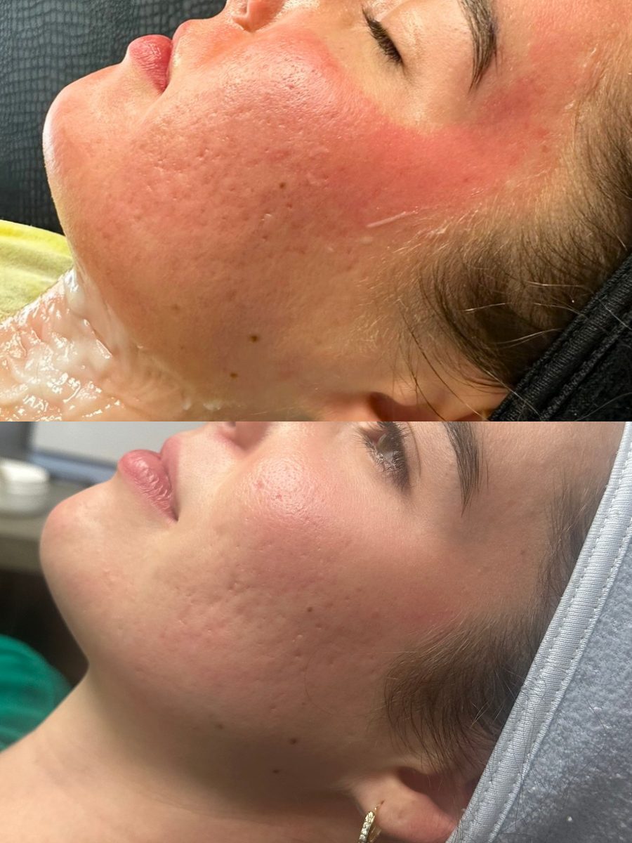 PRP and PRF microneedling treatment 3