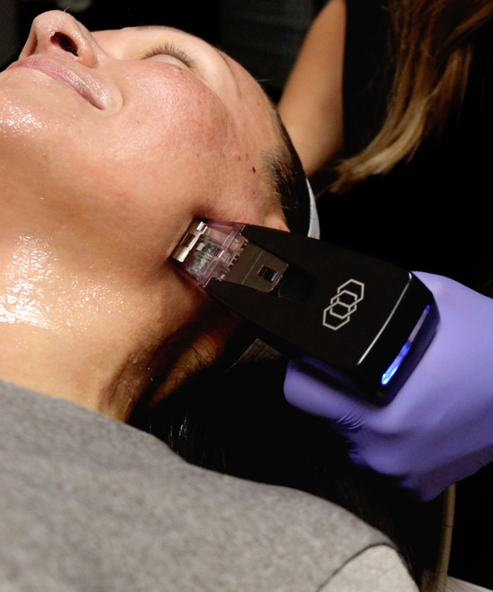 Morpheus8 RF Microneedling