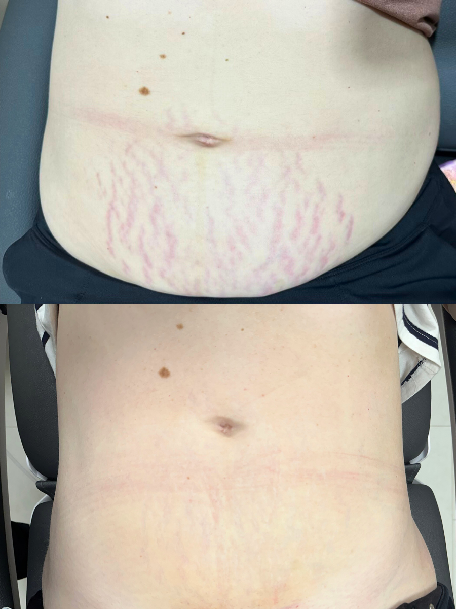 morpheus8 rf microneedling