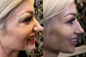 40 units of Botox before and after