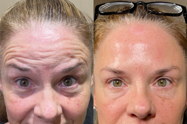 40 units of Botox before and after