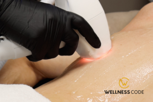 Laser Hair Removal treatment 