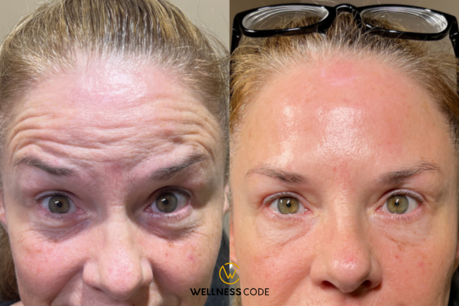 40 units of Botox before and after