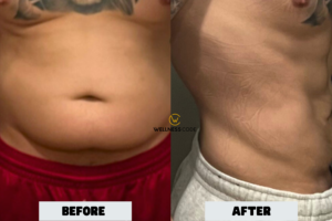 Peptide therapy Before And After 