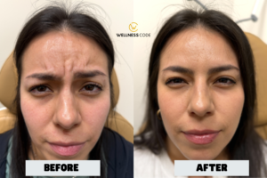 Botox Before and After