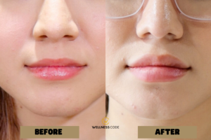How Long Dose Lip Fillers Last
