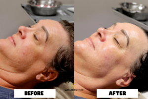Hydrafacial Before and After