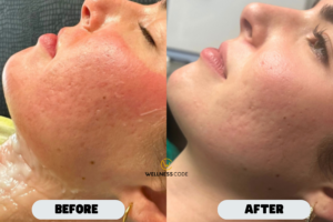 Microdermabrasion Before and After