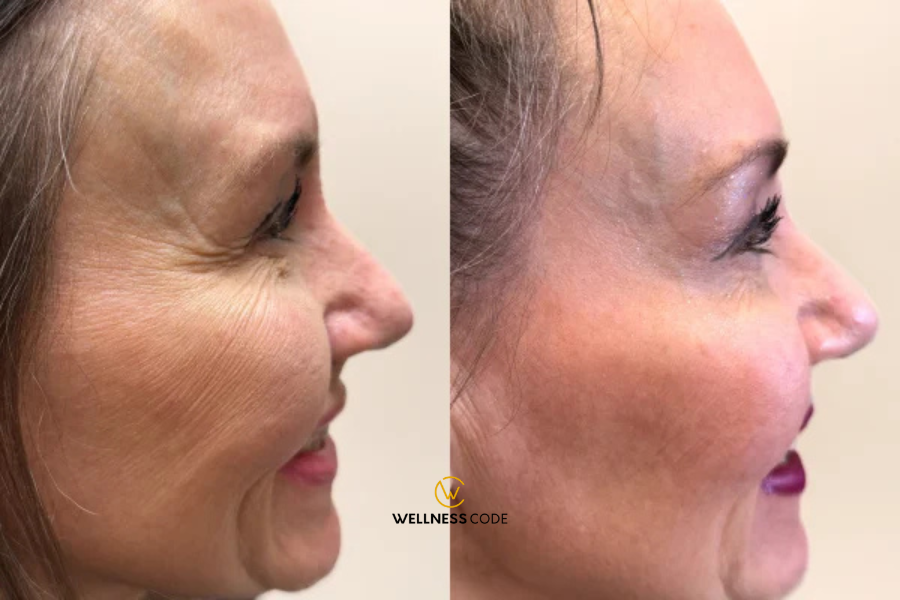 How Long Does Botox Last