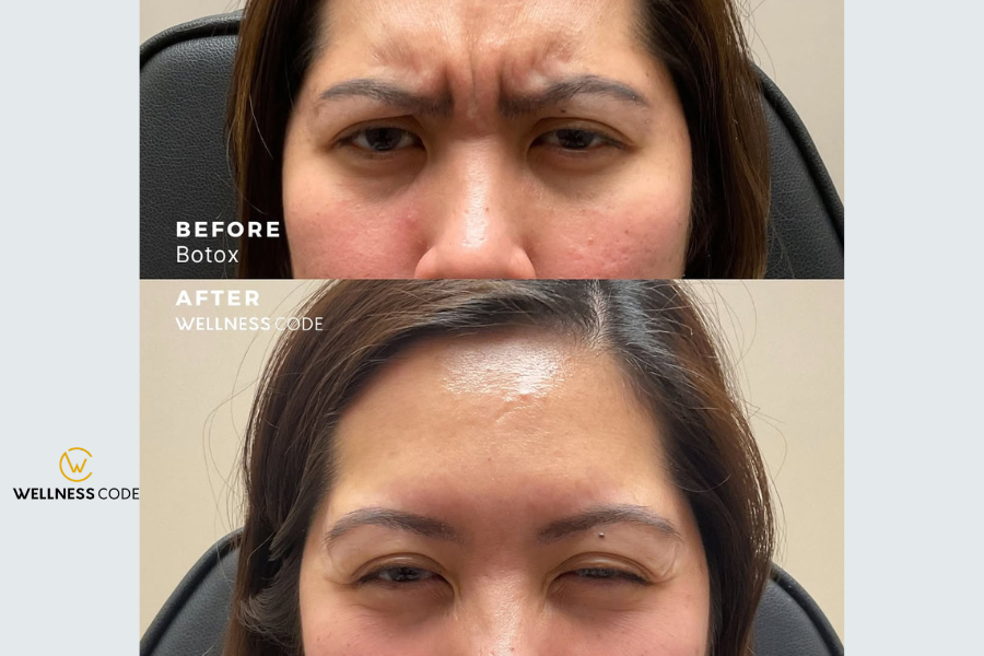 How Many Botox Units in a Syringe