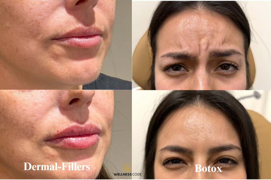 Dermal Fillers vs. Botox