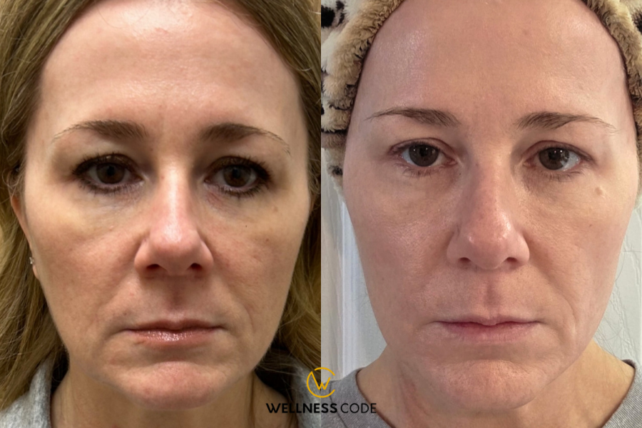 How Much Does Sculptra Cost