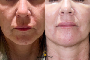 How Long Does Sculptra Last