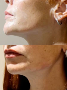 dermal filler before and after photo