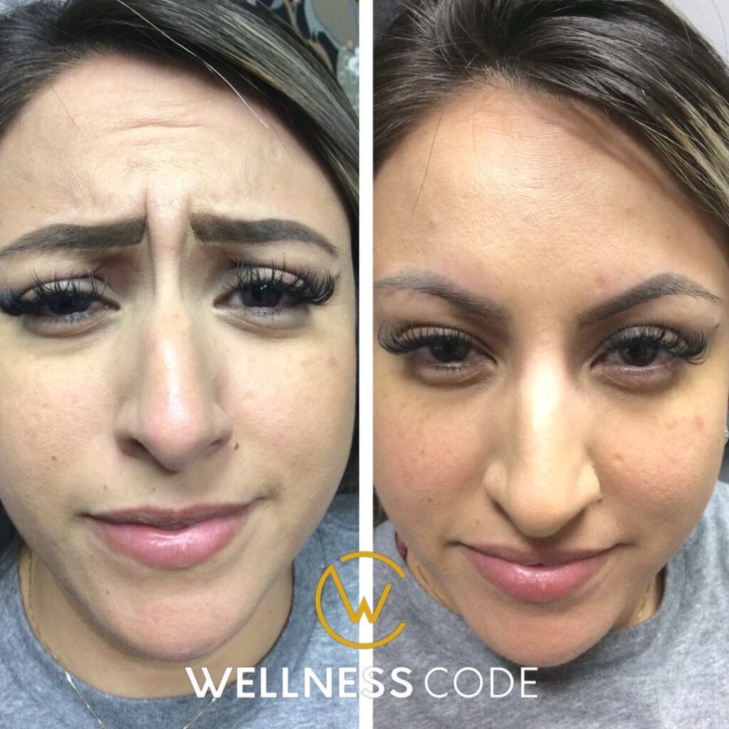 2 Vials of Sculptra Before and After