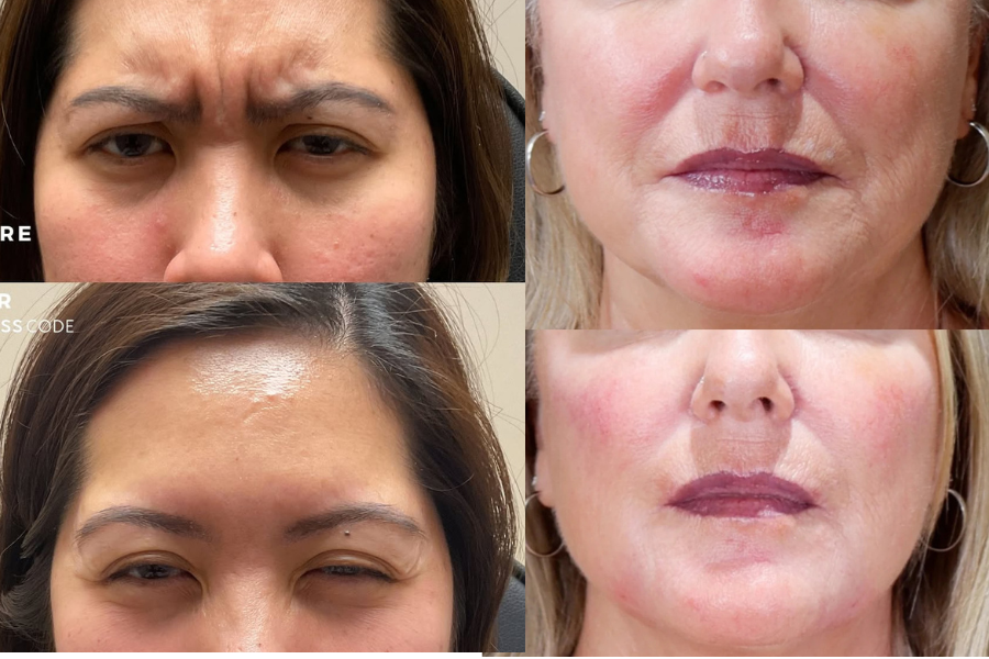 botox vs sculptra